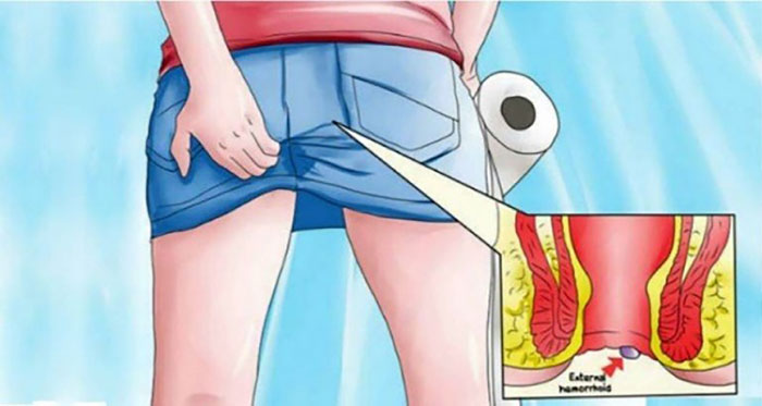 Hình minh họa giải phẫu búi trĩ ở hậu môn